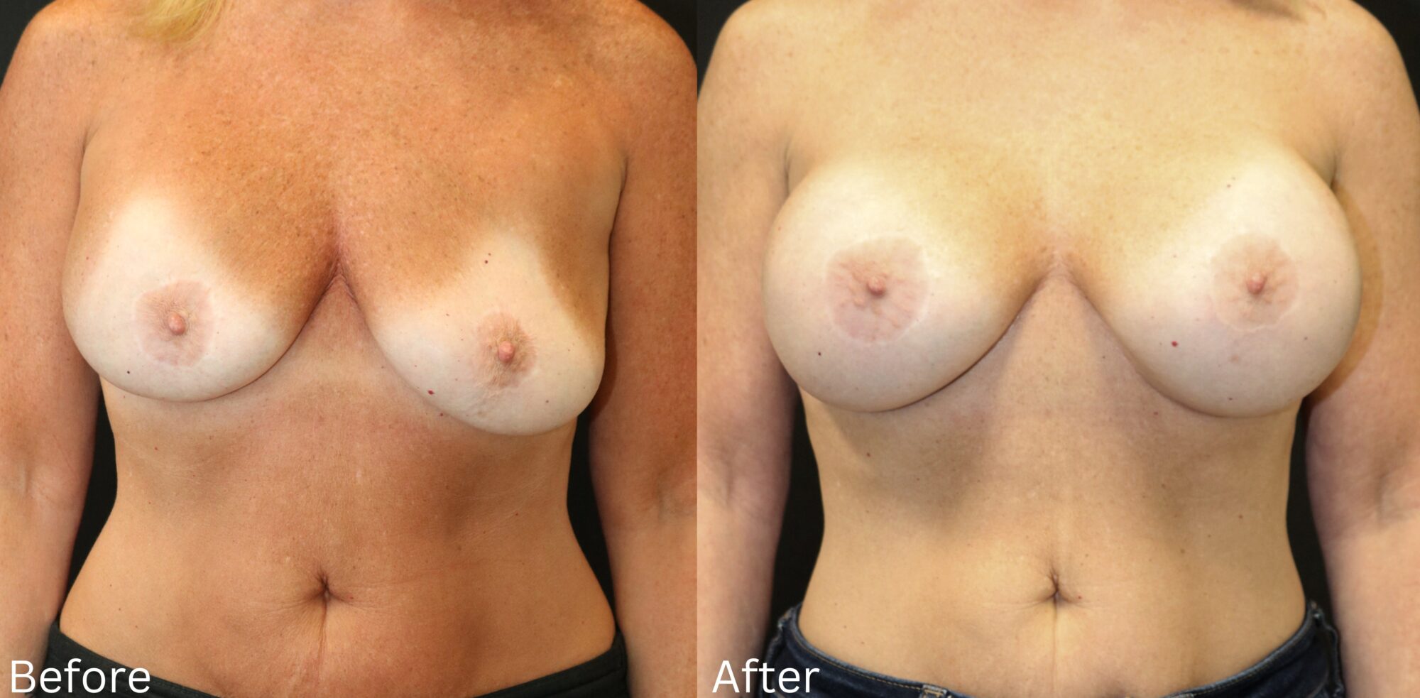 Breast Augmentation