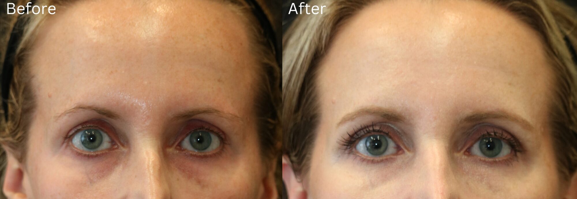 Brow Lift