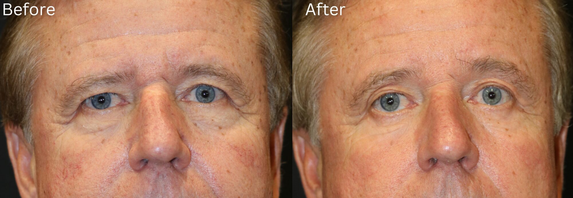 Brow Lift