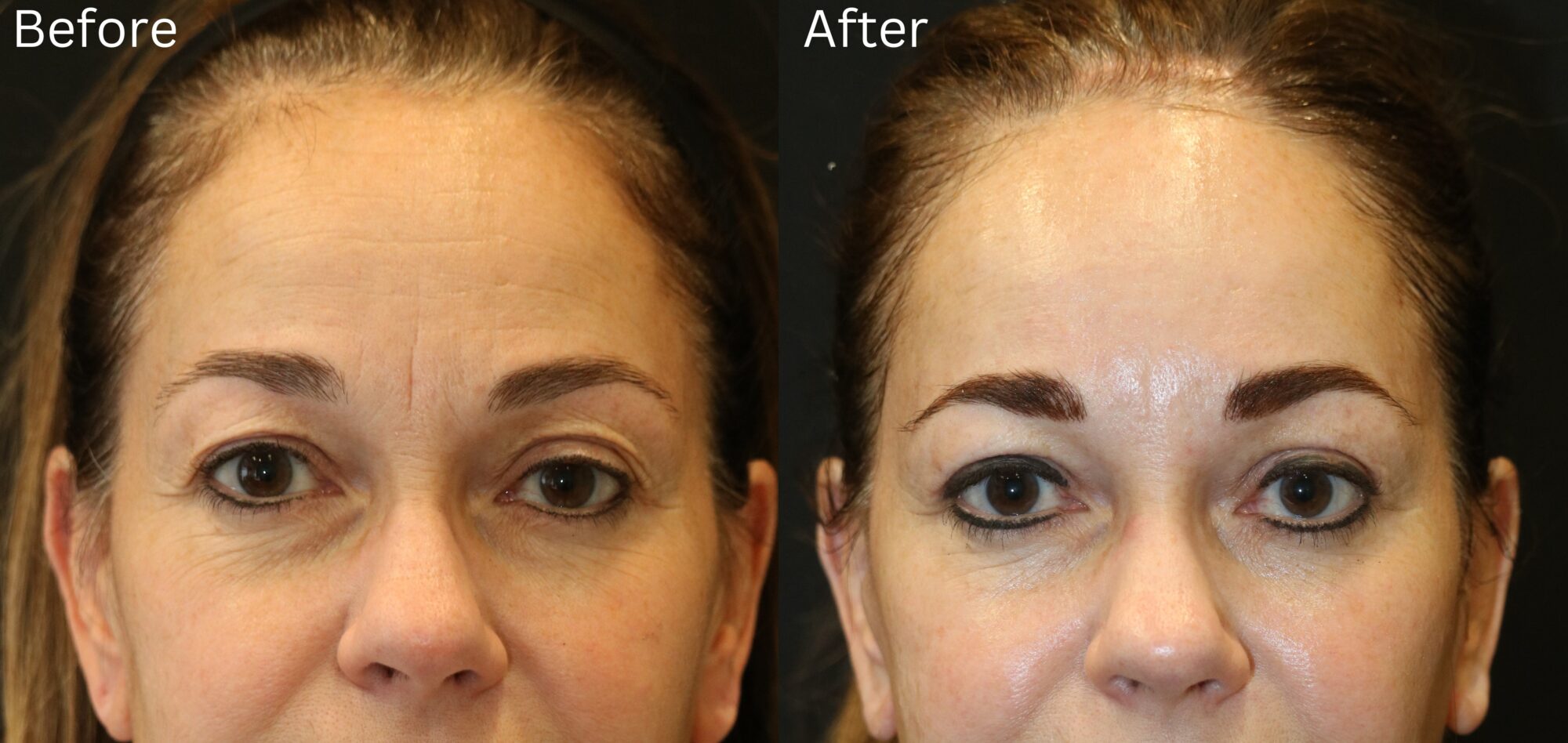 Brow Lift