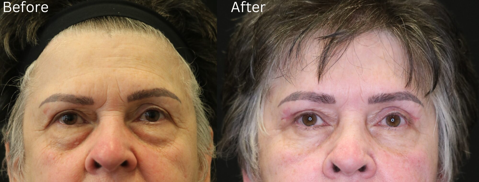 Brow Lift
