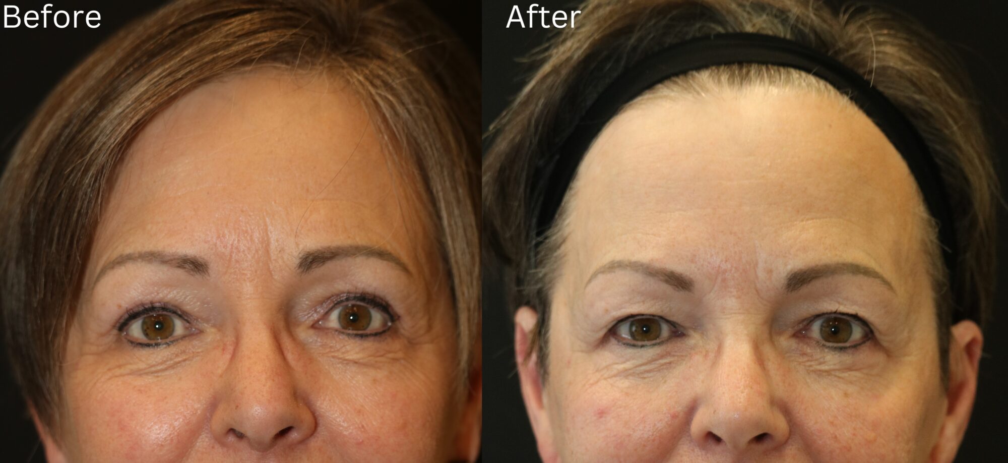 Brow Lift