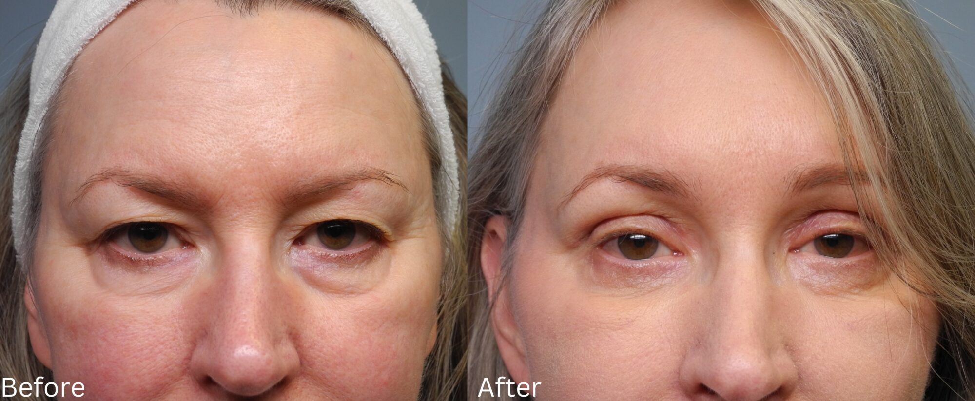 Brow Lift