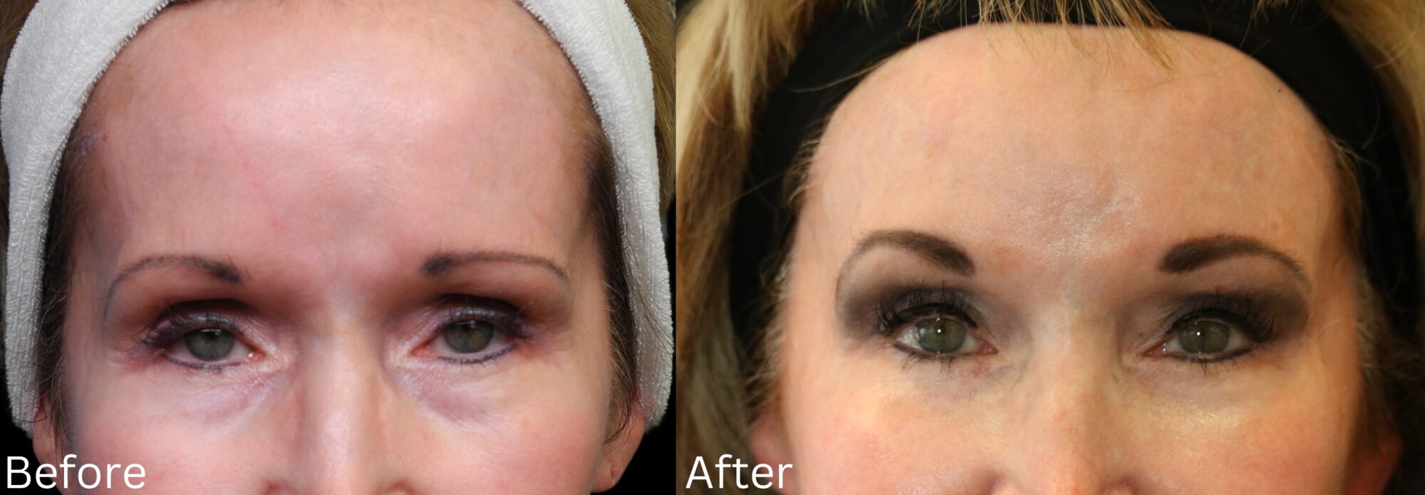 Brow Lift