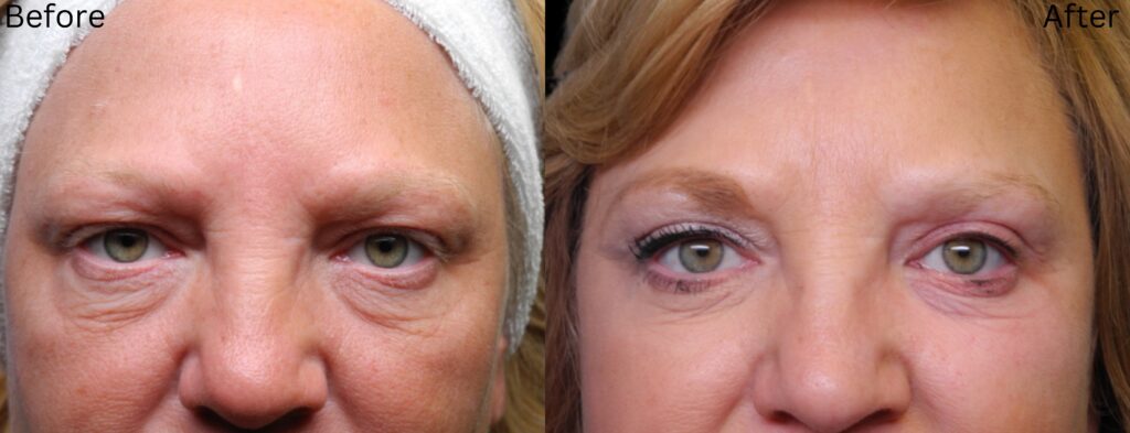 Brow Lift