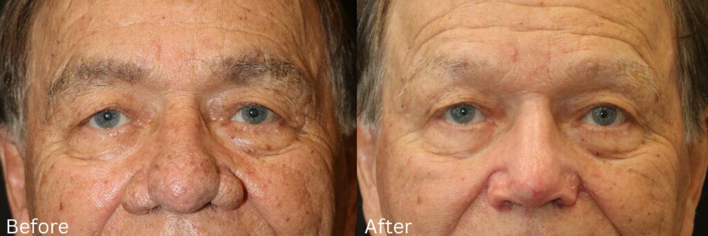 Surgical Laser Resurfacing (CO2)