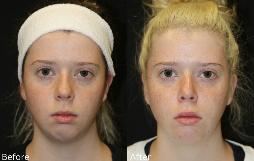 Chin Implant