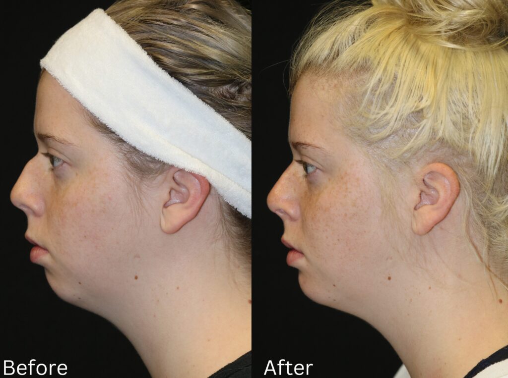 Rhinoplasty