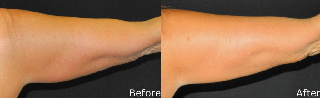 Coolsculpting