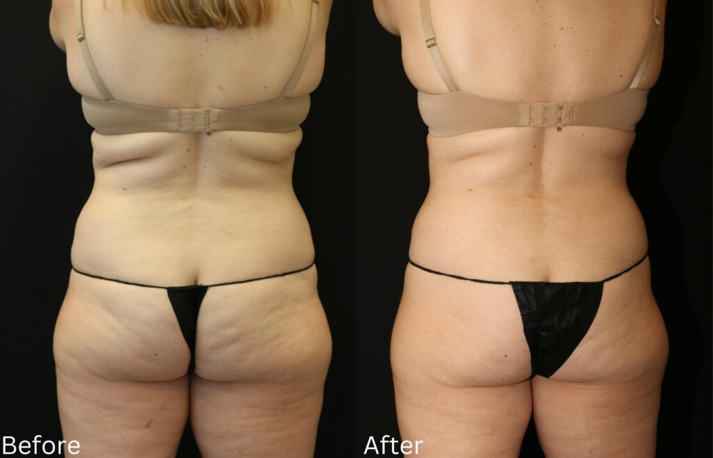 Coolsculpting