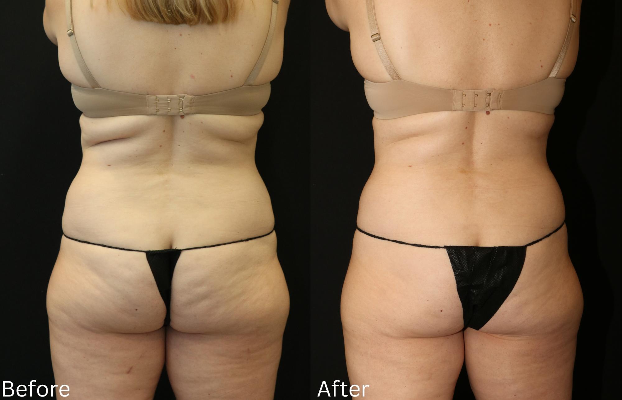 Coolsculpting