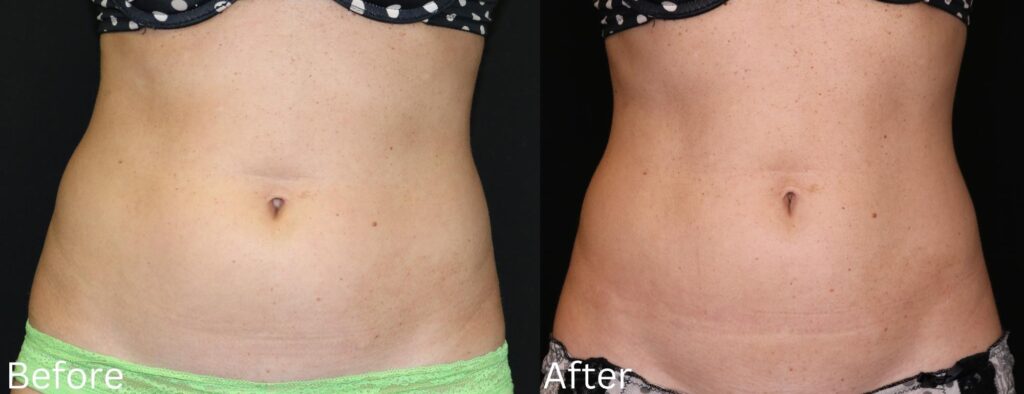 Coolsculpting