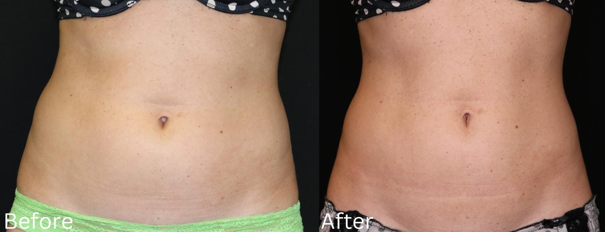 Coolsculpting