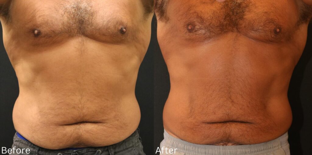 Coolsculpting