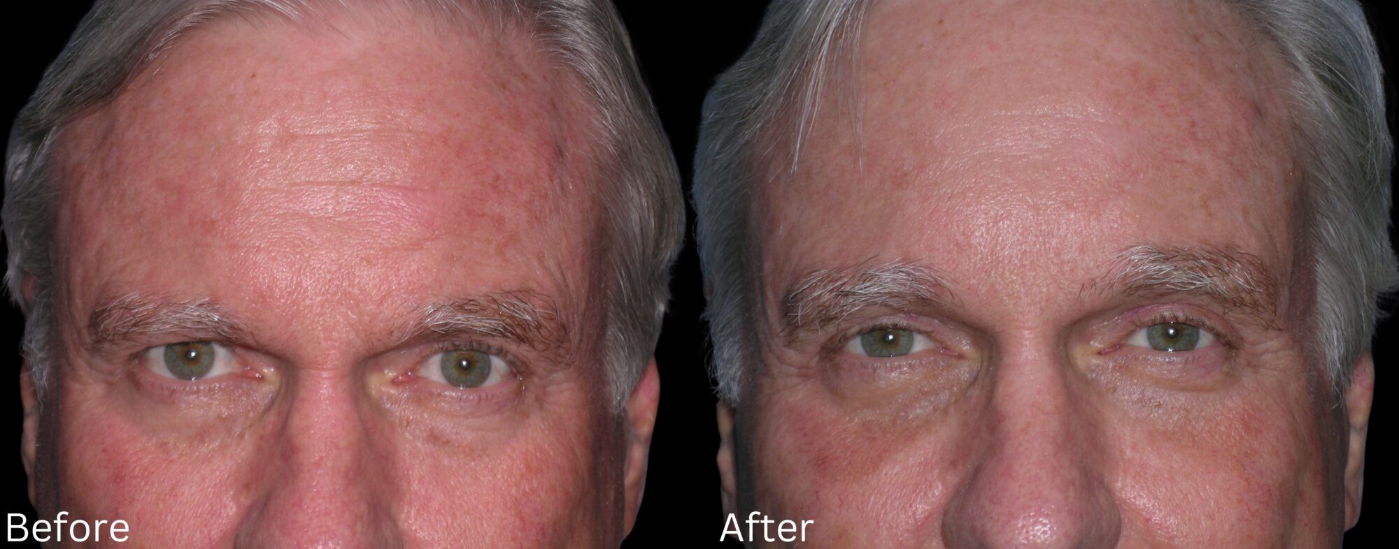 Brow Lift