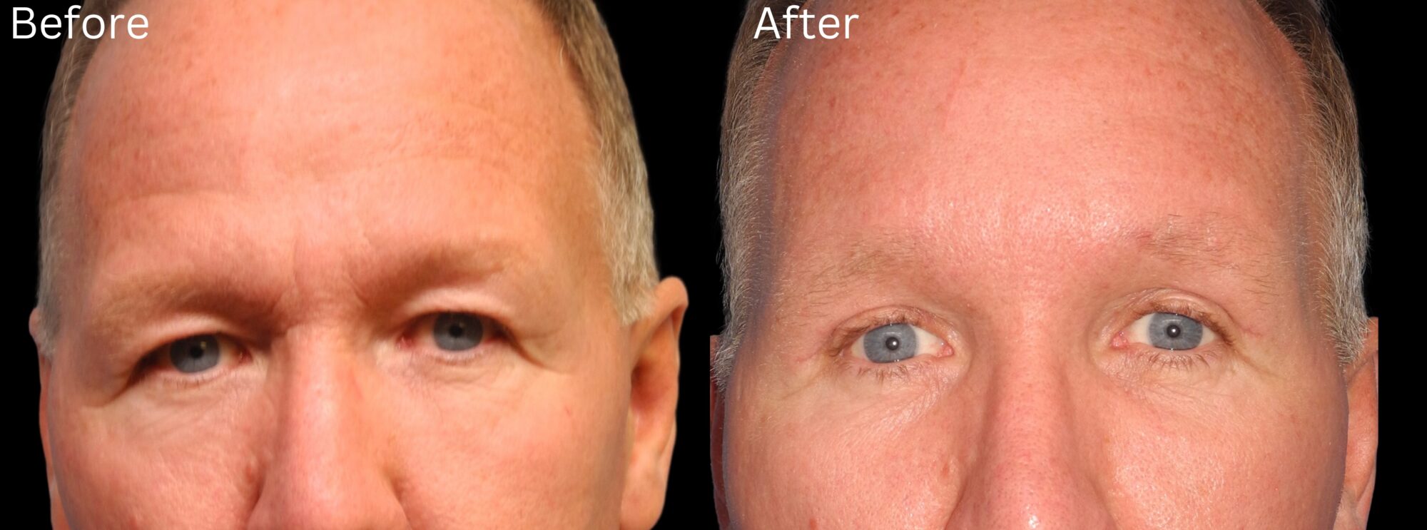 Brow Lift