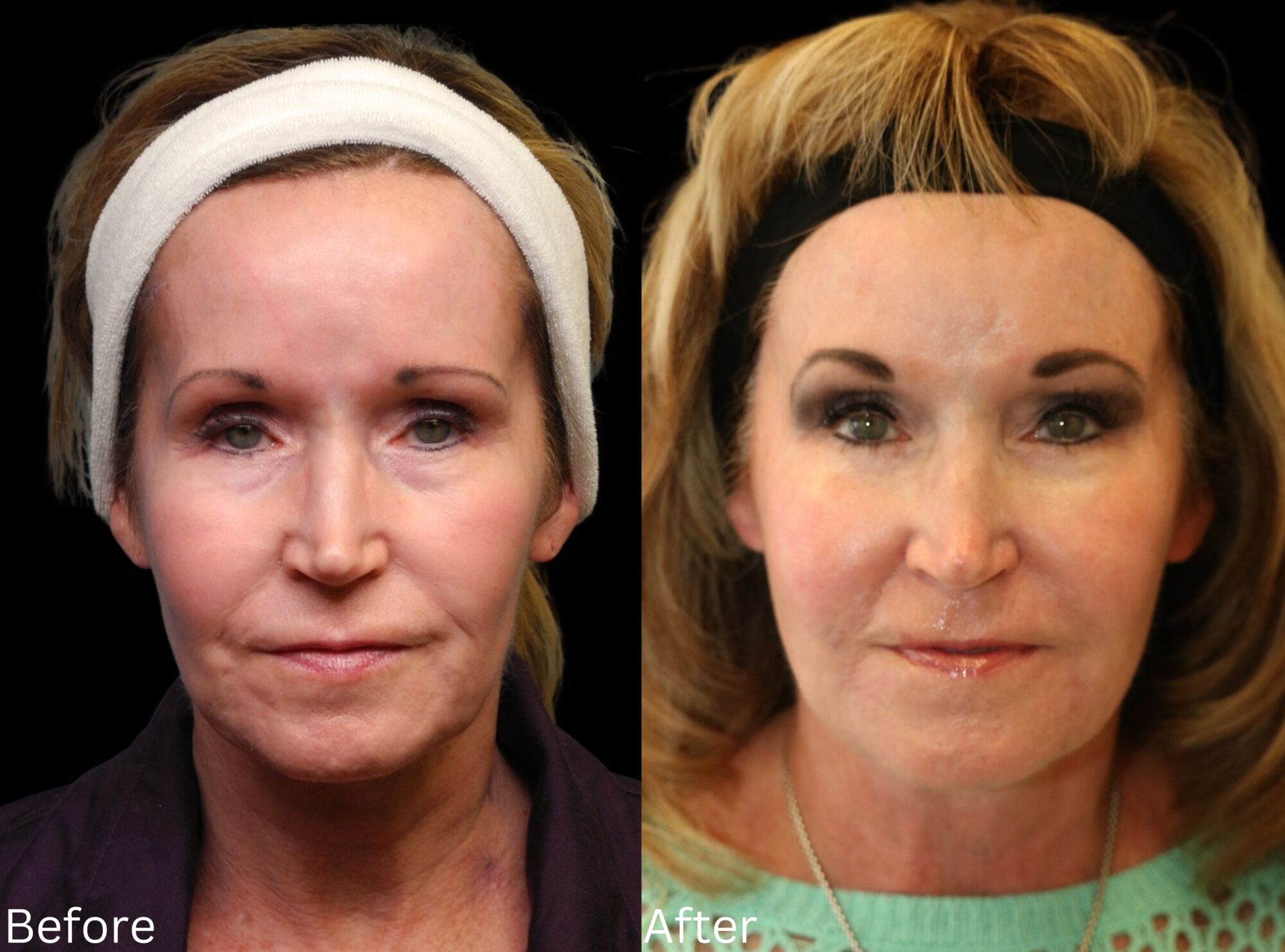 Website BAs - 173 Facelift and Neck Lift