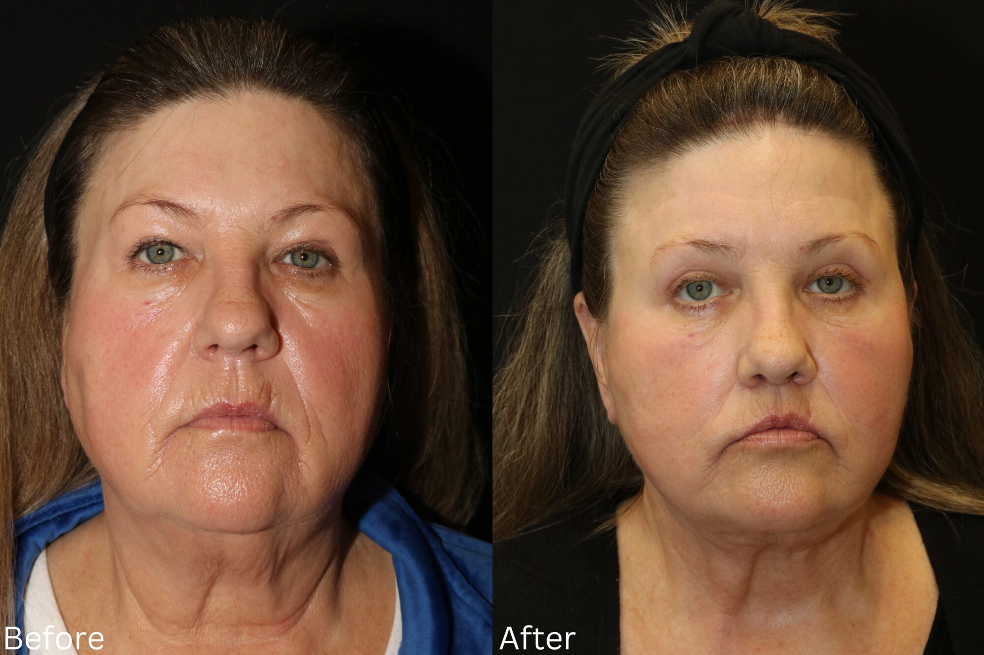 Facelift and Neck Lift