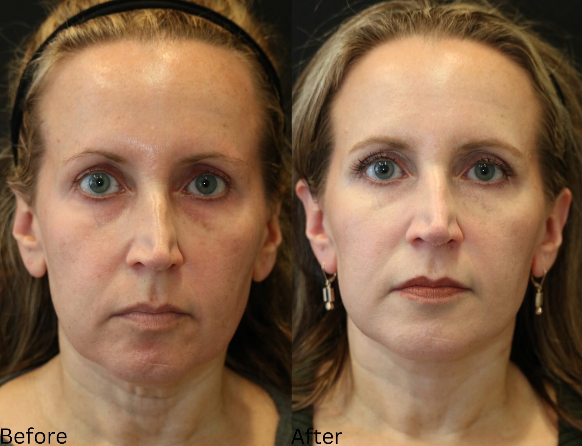 Facelift and Neck Lift