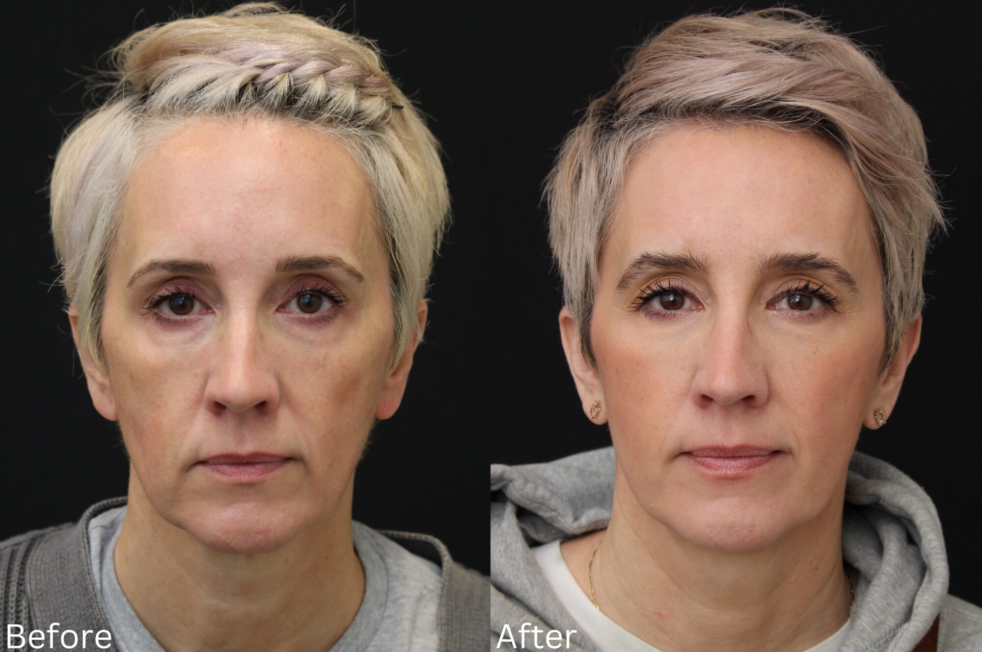 Facelift and Neck Lift