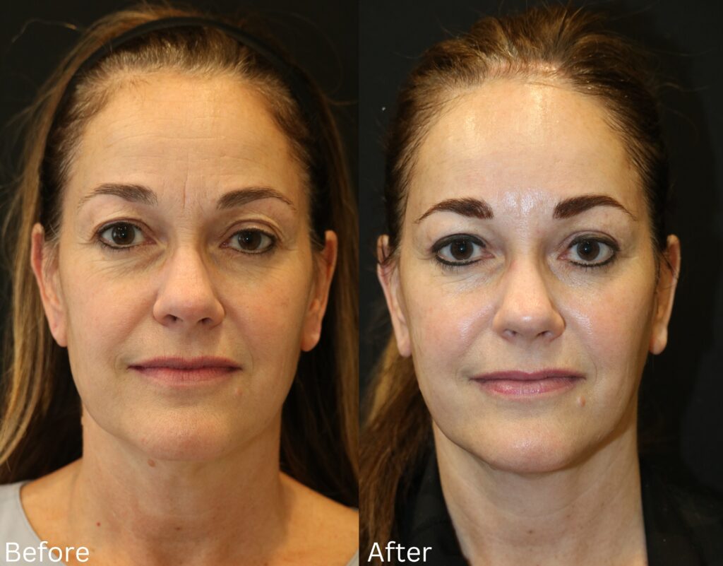 Facelift and Neck Lift