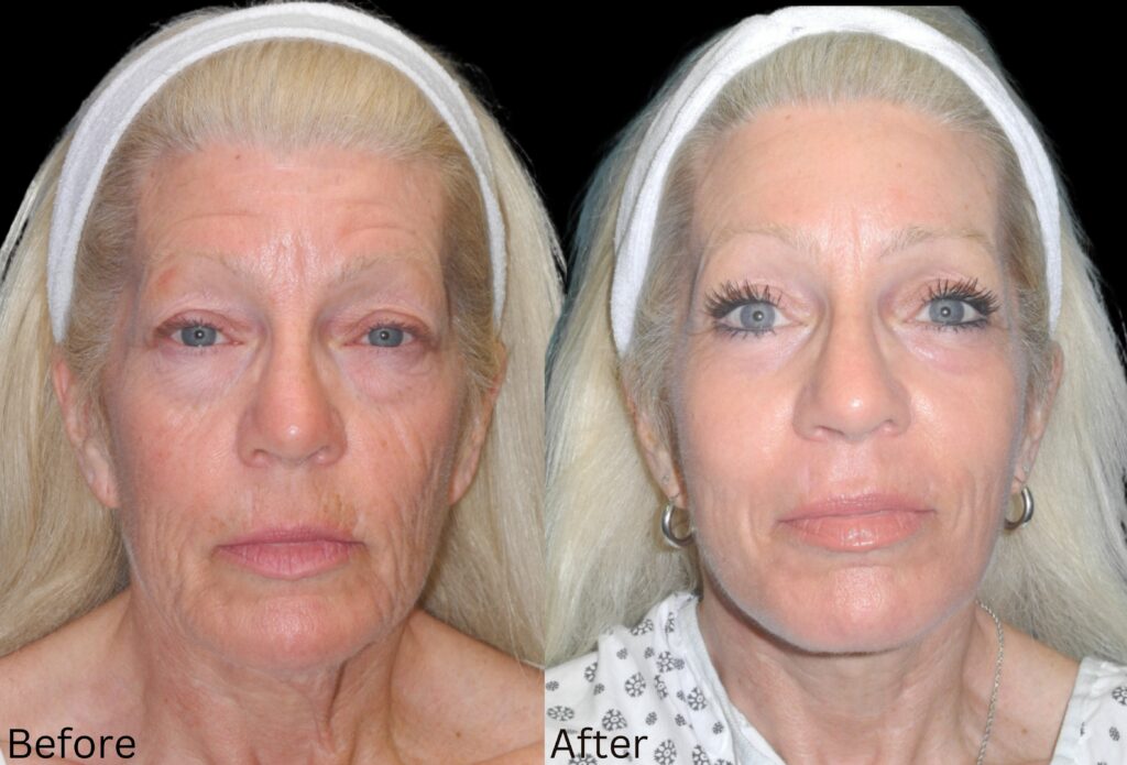 Facelift and Neck Lift