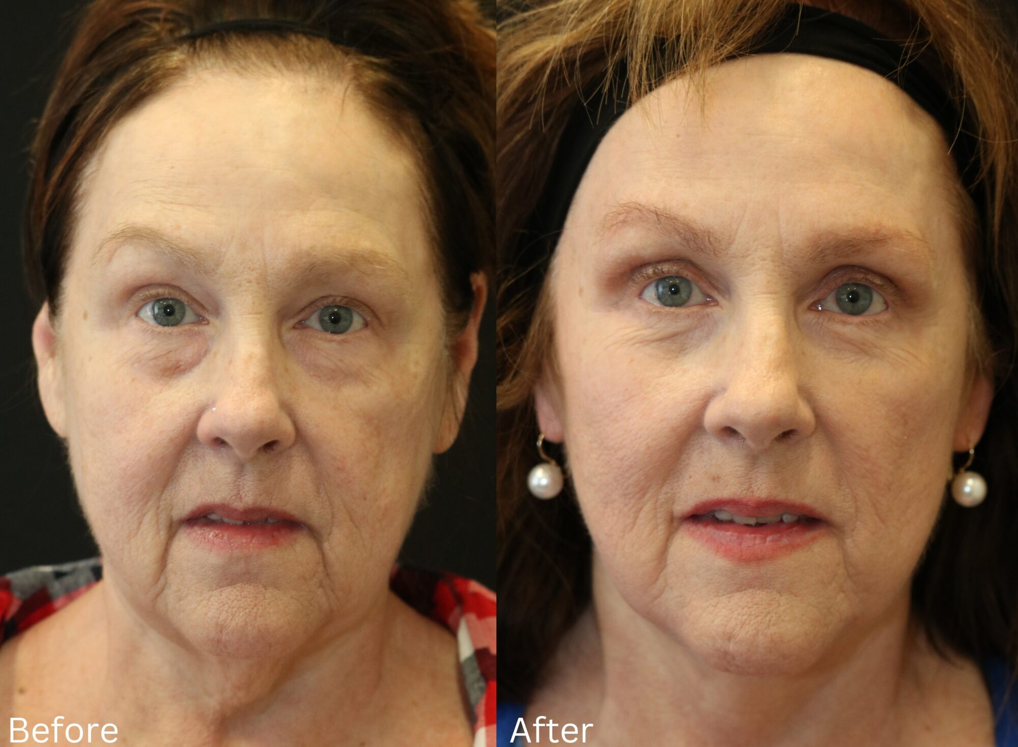 Facelift and Neck Lift