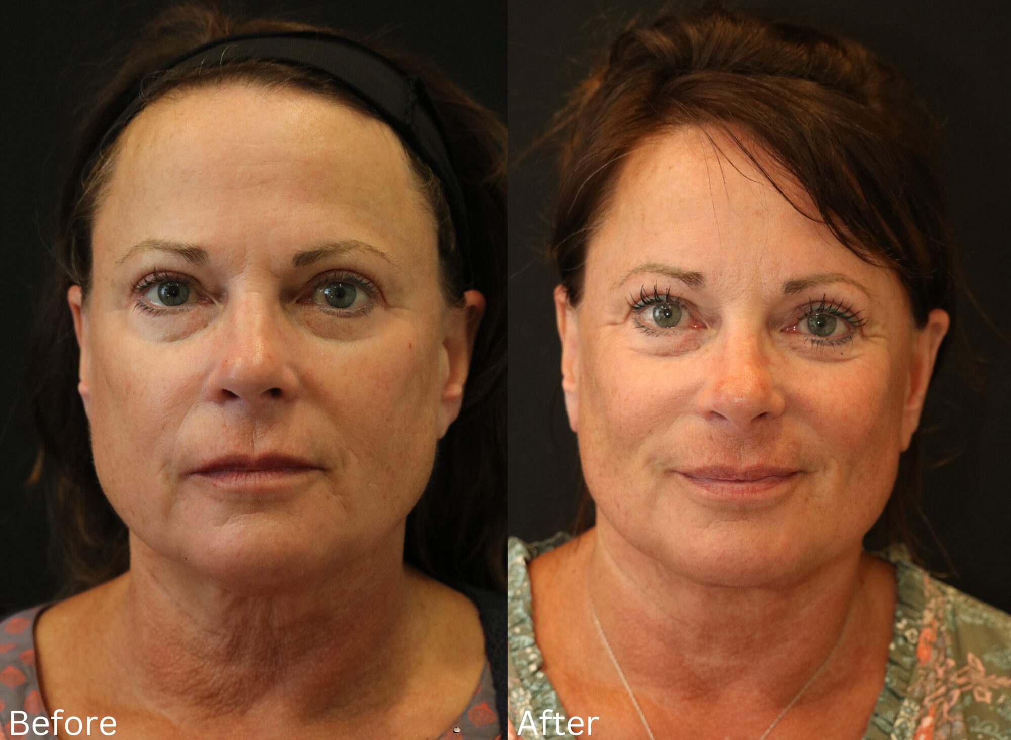 Facelift and Neck Lift