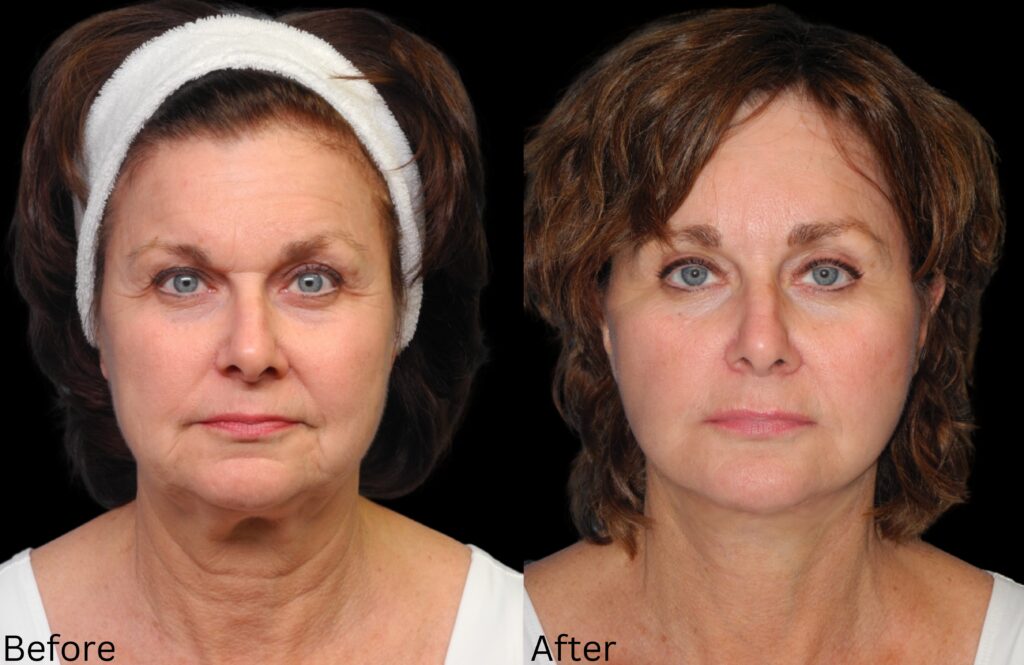 Facelift and Neck Lift