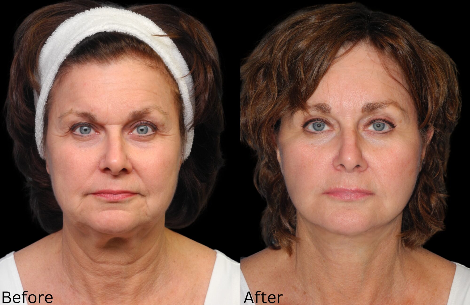 Facelift and Neck Lift