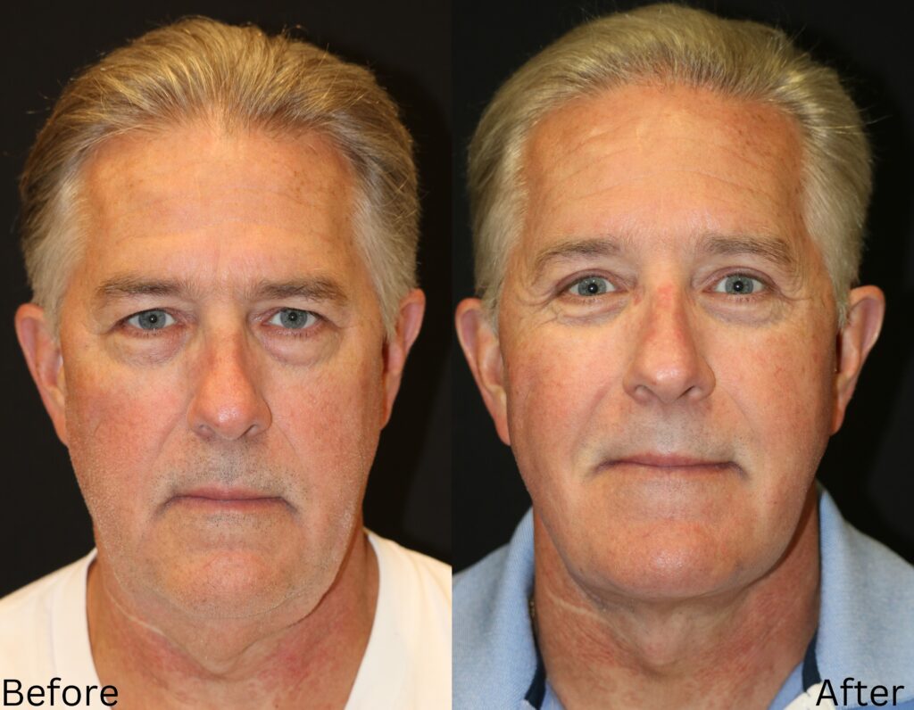 Facelift and Neck Lift