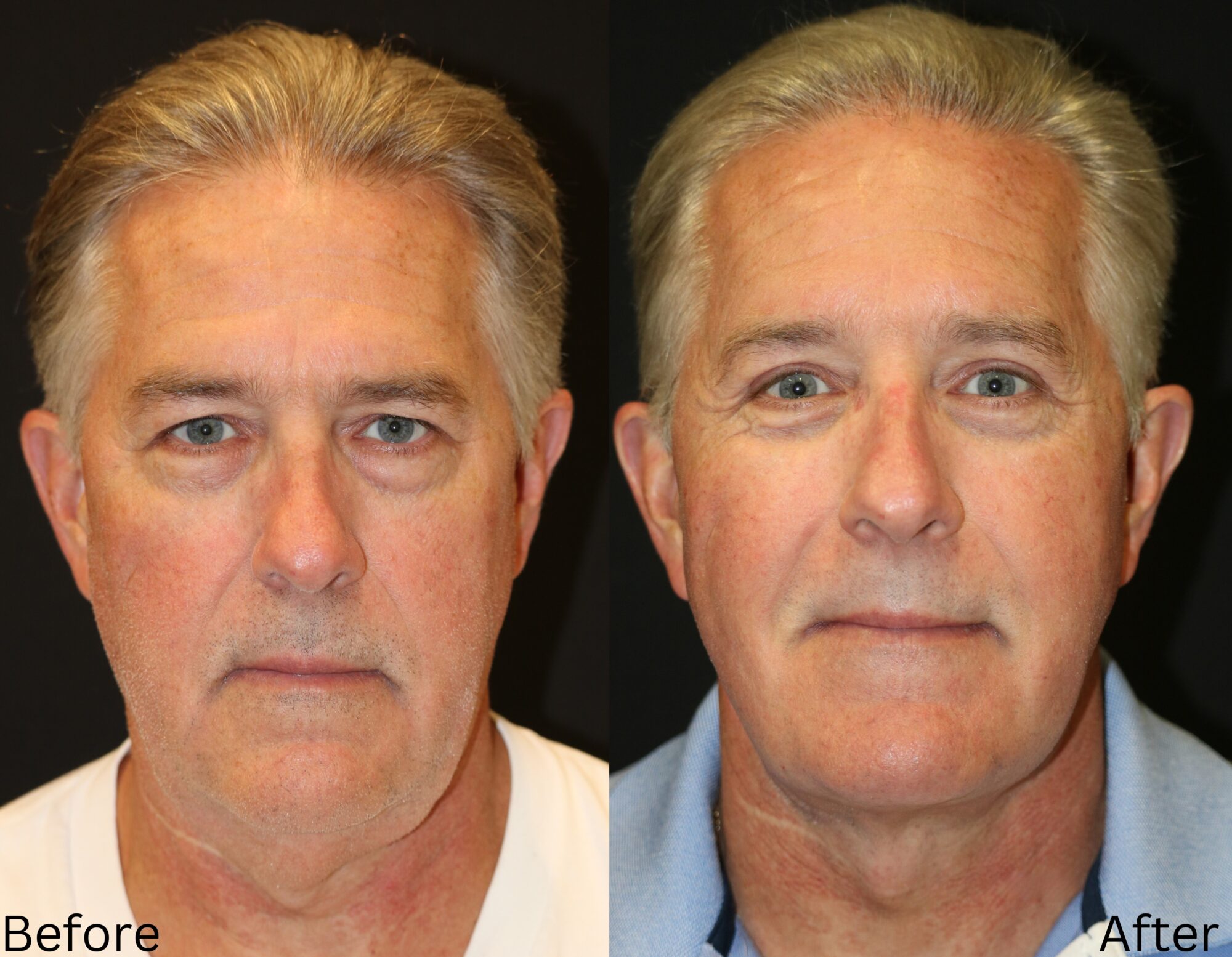 Facelift and Neck Lift