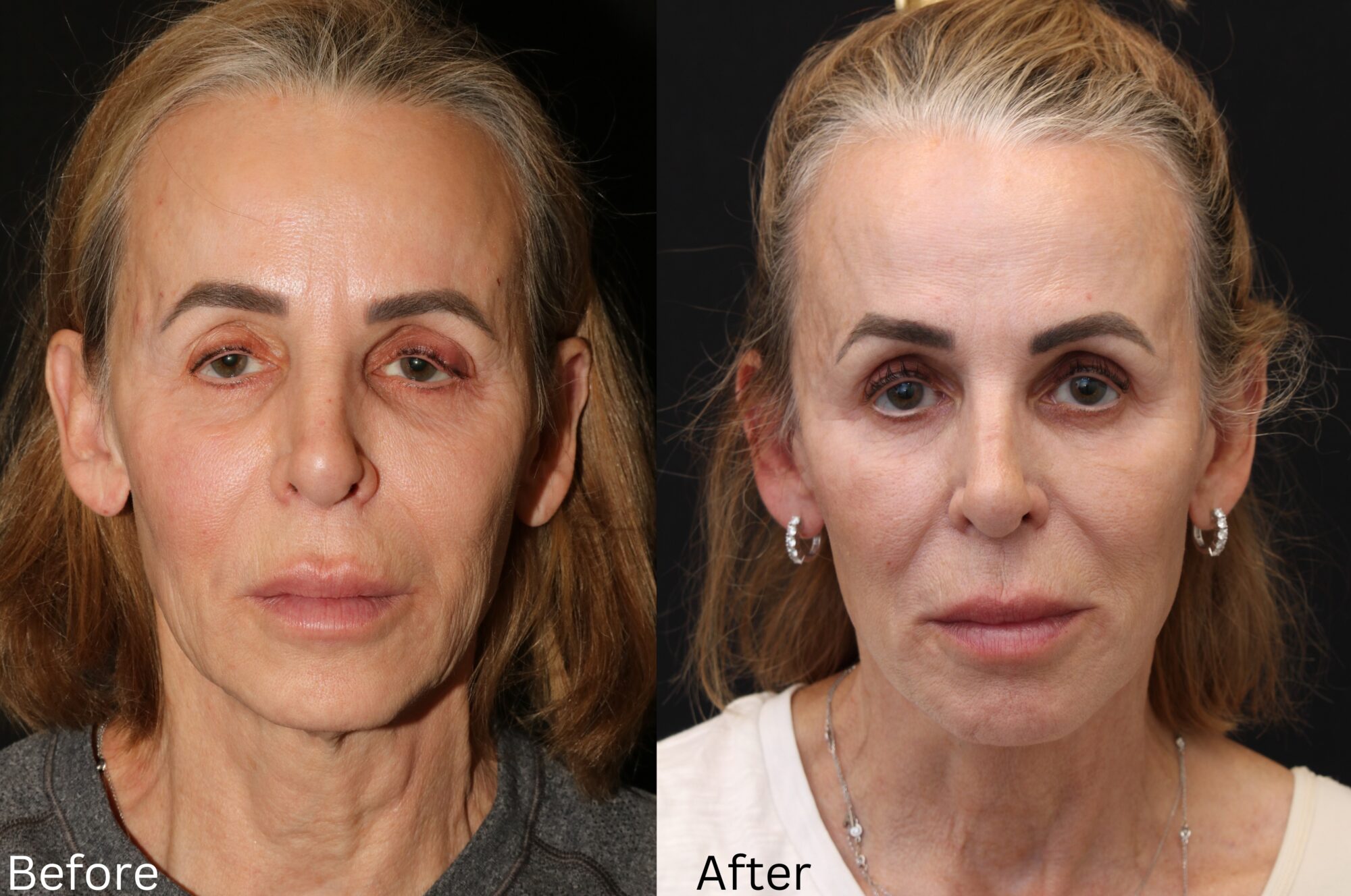 Facelift and Neck Lift
