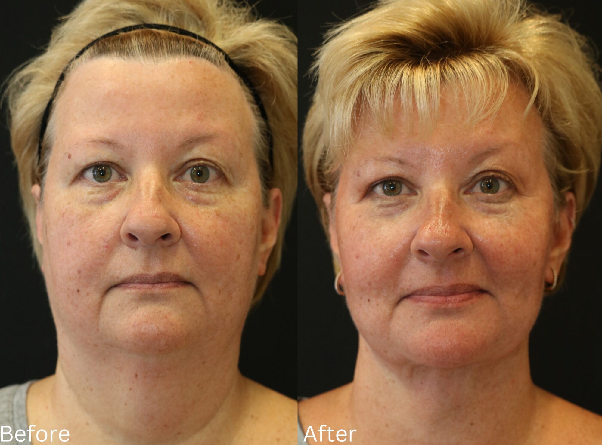 Facelift and Neck Lift
