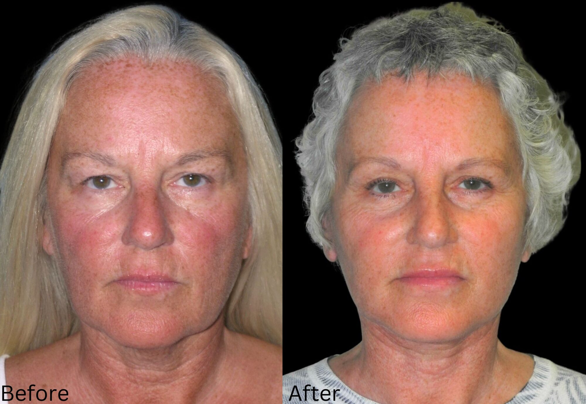 Facelift and Neck Lift