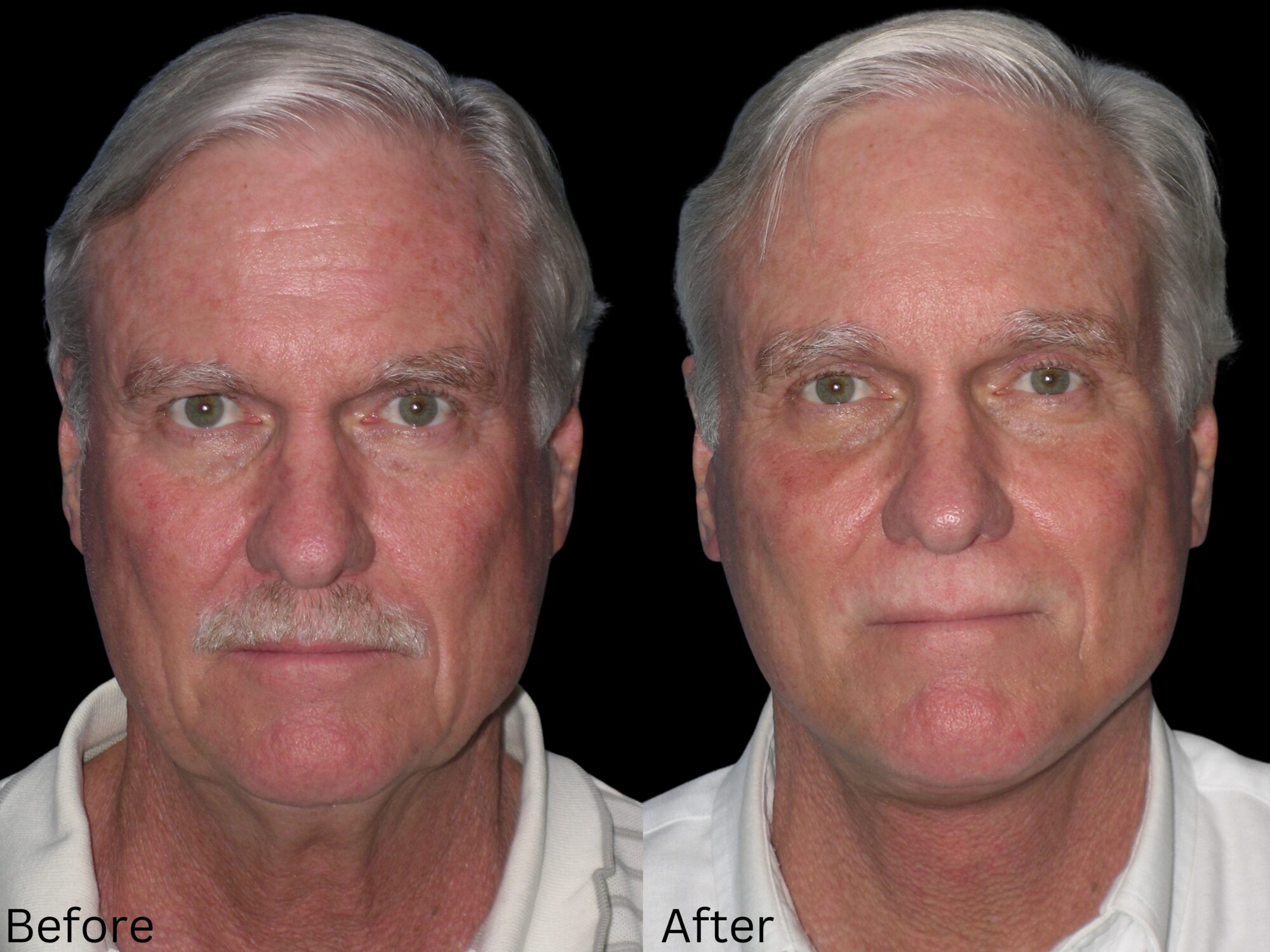 Facelift and Neck Lift