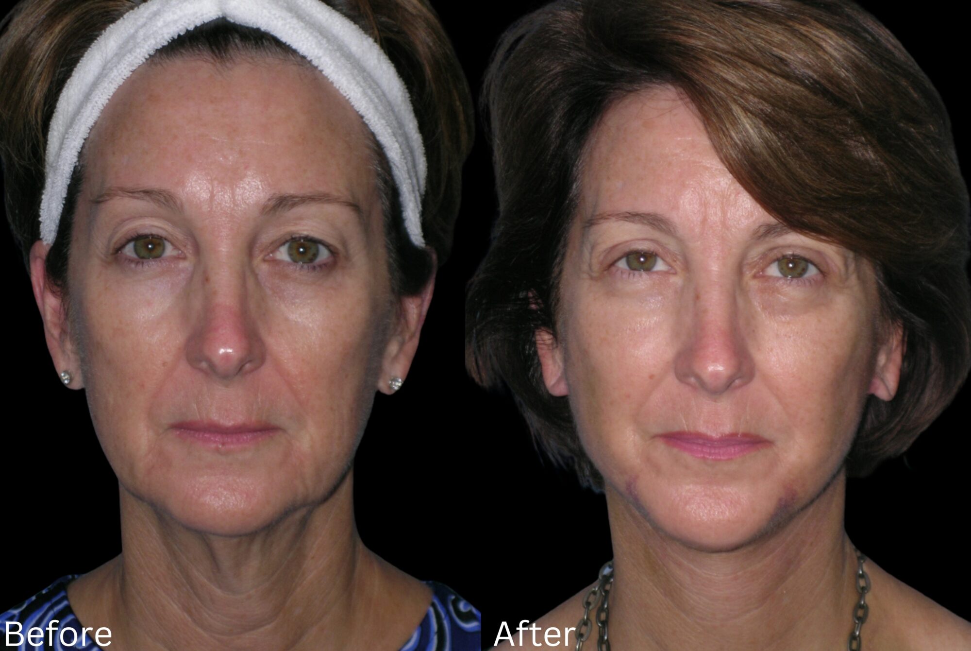 Facelift and Neck Lift