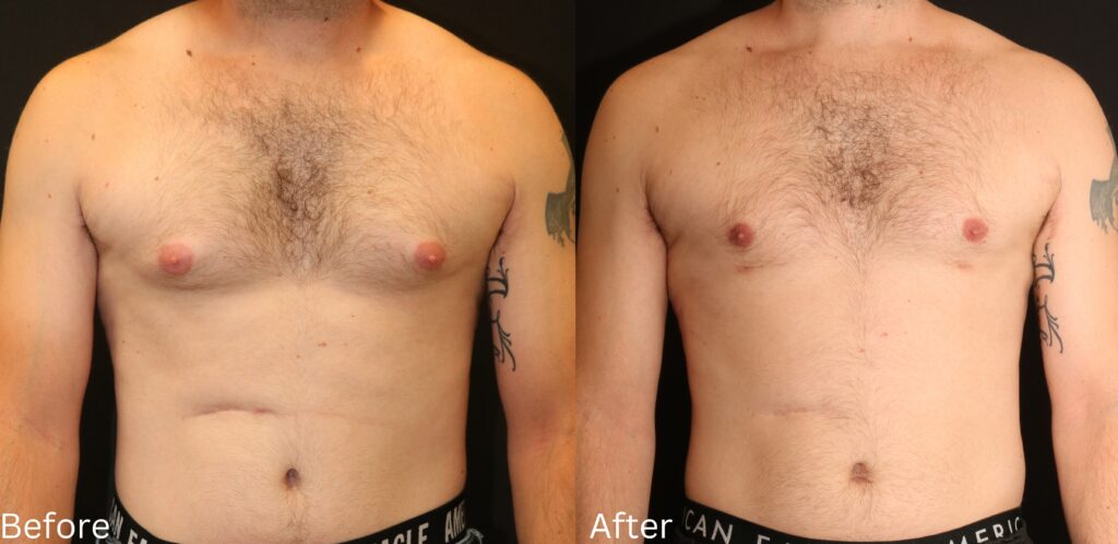 Gynecomastia