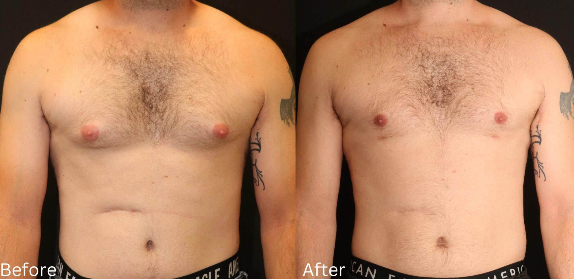 Gynecomastia