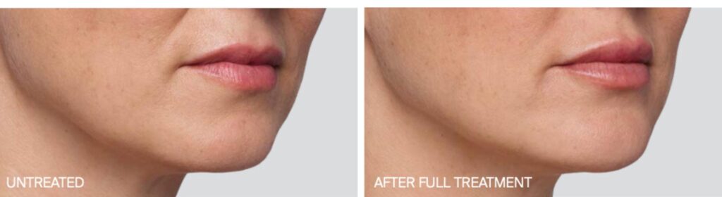 Juvederm Filler