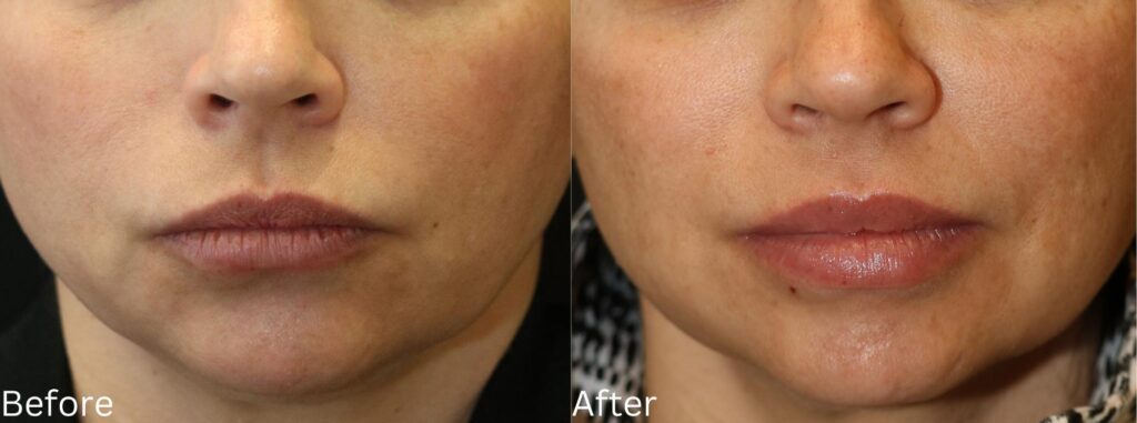 Juvederm Filler