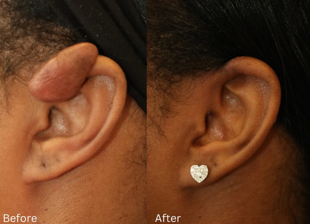 Keloid Removal