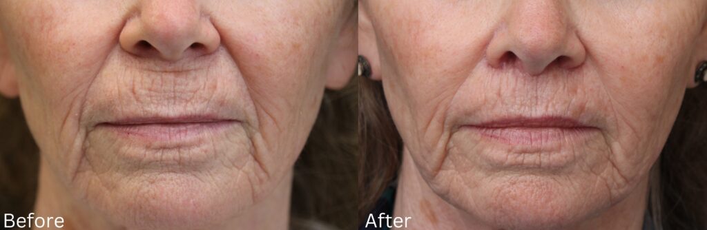 Lip Lift