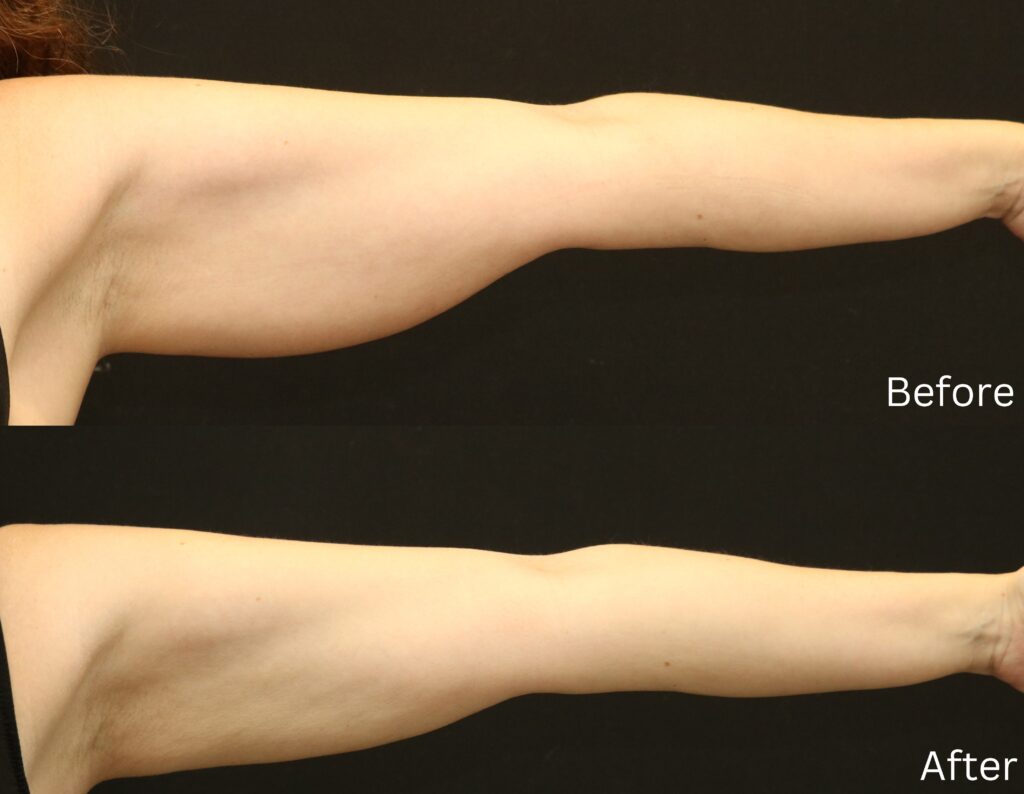 Liposuction
