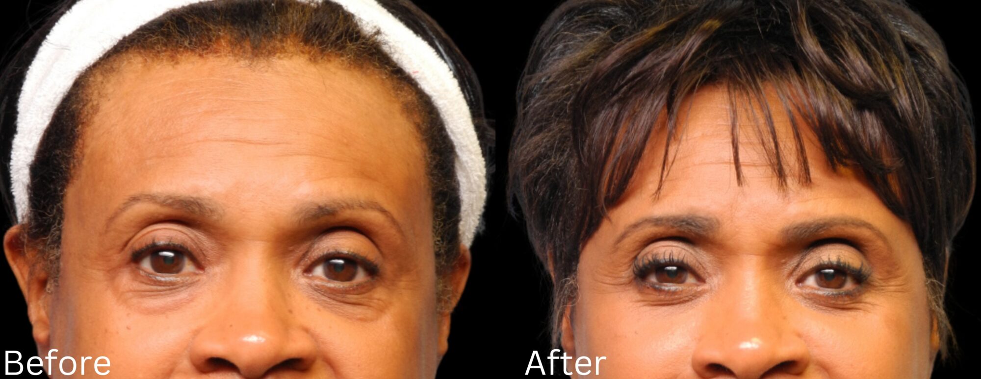 Website BAs - 139 Eyelid Lift
