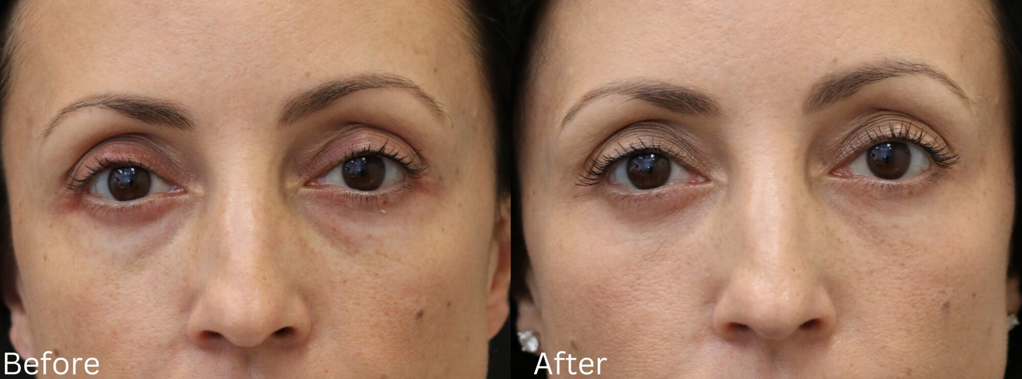 Eyelid Lift