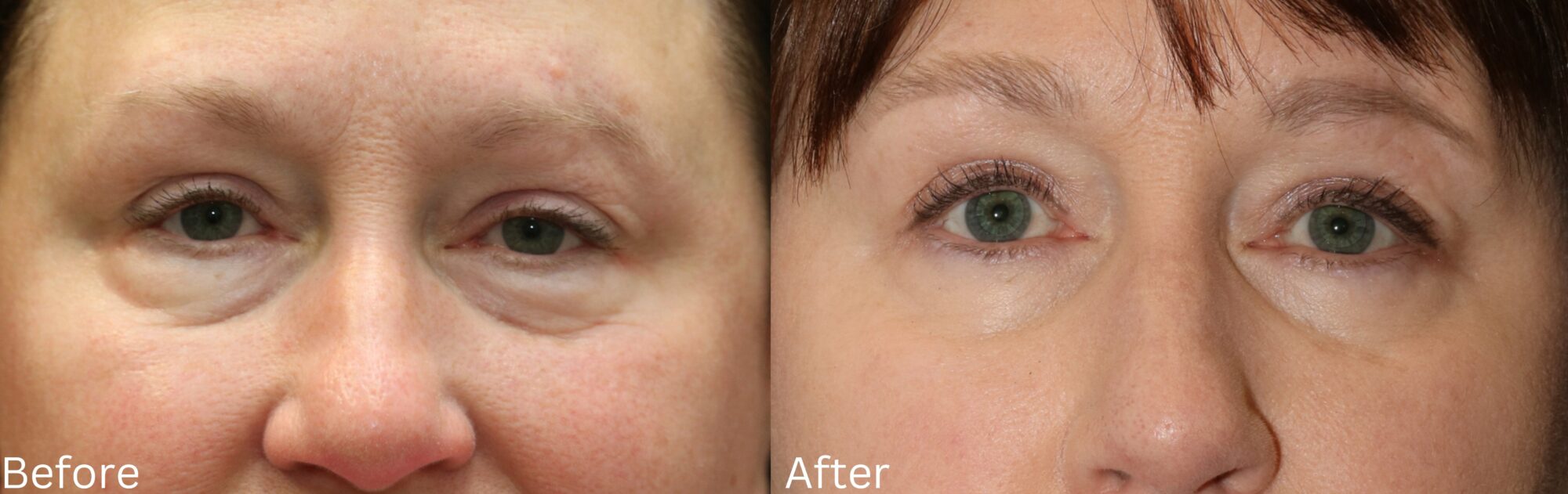 Website BAs - 151 Eyelid Lift