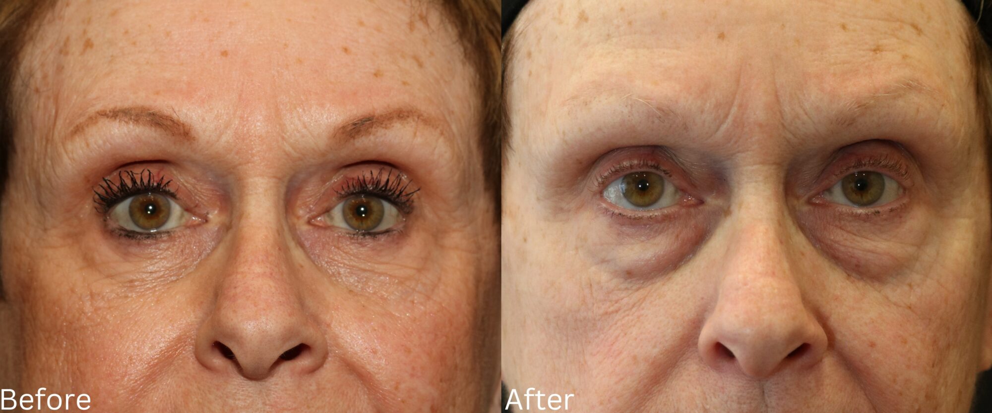 Website BAs - 153 Eyelid Lift