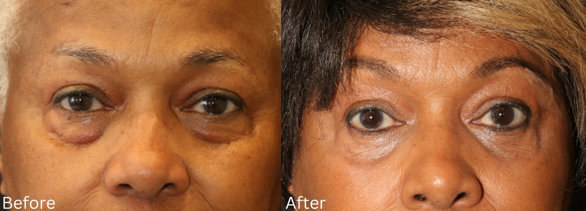 Website BAs - 154 Eyelid Lift