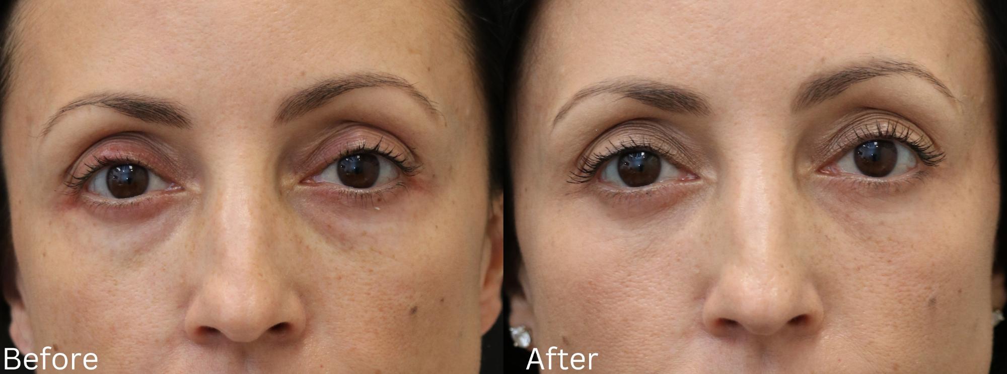 Skin Tightening
